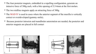 • The four posterior magnets, embedded in a repelling configuration, generate an
intrusive force of 300g each, with a bite opening of 5.5-6mm at the first molars.
• The two midline magnets apply an attracting force of 300g.
• The MAD IV is used in cases where the anterior segment of the maxilla is vertically
correct or overdeveloped (gummy smile).
• Because posterior intrusion and mandibular autorotation are needed, the posterior and
anterior magnets are placed in full contact
 