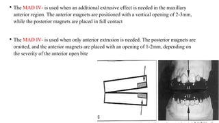 • The MAD IV- is used when an additional extrusive effect is needed in the maxillary
anterior region. The anterior magnets are positioned with a vertical opening of 2-3mm,
while the posterior magnets are placed in full contact
• The MAD IV- is used when only anterior extrusion is needed. The posterior magnets are
omitted, and the anterior magnets are placed with an opening of 1-2mm, depending on
the severity of the anterior open bite
 