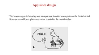 Appliance design
• The lower magnetic housing was incorporated into the lower plate on the dental model.
Both upper and lower plates were then bonded to the dental arches.
 