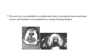 • The arch wire was embedded in a molded resin sheet overlying the incisor and molar
crowns, and formation was completed in a vacuum-forming machine.
 