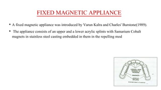 FIXED MAGNETIC APPLIANCE
• A fixed magnetic appliance was introduced by Varun Kalra and Charles' Burstone(1989).
• The appliance consists of an upper and a lower acrylic splints with Samarium Cobalt
magnets in stainless steel casting embedded in them in the repelling mod
 