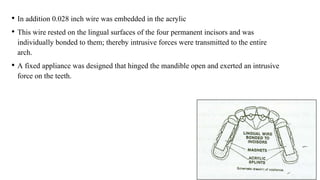 • In addition 0.028 inch wire was embedded in the acrylic
• This wire rested on the lingual surfaces of the four permanent incisors and was
individually bonded to them; thereby intrusive forces were transmitted to the entire
arch.
• A fixed appliance was designed that hinged the mandible open and exerted an intrusive
force on the teeth.
 