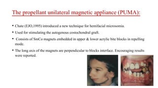 The propellant unilateral magnetic appliance (PUMA):
• Chate (EJO,1995) introduced a new technique for hemifacial microsomia.
• Used for stimulating the autogenous costochondral graft.
• Consists of SmCo magnets embedded in upper & lower acrylic bite blocks in repelling
mode.
• The long axis of the magnets are perpendicular to blocks interface. Encouraging results
were reported.
 