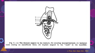 J. Pros. Den. Sept.-Oct., 1960
 