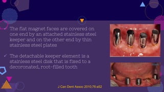  The flat magnet faces are covered on
one end by an attached stainless steel
keeper and on the other end by thin
stainless steel plates
 The detachable keeper element is a
stainless steel disk that is fixed to a
decoronated, root-filled tooth
J Can Dent Assoc 2010;76:a52
 