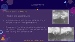 Keeper types
1)The cement-in keeper.
 Fitted in one appointment
 Not suitable for small roots because of the
danger of lateral root perforation
 A magnetic retention element is used as a
handle to hold cement-in keeper element for
trial-fitting and cementation.
J Prosthet Dent 1983:49; 607-18.
 