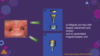 a) Magnet (on top) with
keeper (abutment and
screw)
and b) assembled
magnet-keeper unit.
J Can Dent Assoc 2010;76:a52
 