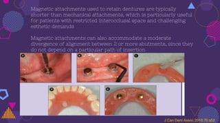 Magnetic attachments used to retain dentures are typically
shorter than mechanical attachments, which is particularly useful
for patients with restricted interocclusal space and challenging
esthetic demands
Magnetic attachments can also accommodate a moderate
divergence of alignment between 2 or more abutments, since they
do not depend on a particular path of insertion
J Can Dent Assoc 2010;76:a52
 