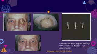 ◍Brass abutment replica analogs
with assembled Magna-cap
components
J Prosthet Dent. 1987:55;334-40.
 