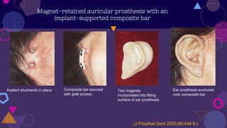 Magnet-retained auricular prosthesis with an
implant-supported composite bar
Two magnets
incorporated into fitting
surface of ear prosthesis
Implant abutments in place. Composite bar secured
with gold screws.
Ear prosthesis anchored
over composite bar.
(J Prosthet Dent 2003;89:446-9.)
 