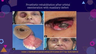 Prosthetic rehabilitation after orbital
exenteration with maxillary defect
Indian J Ophthalmol [serial online] 2014 [cited 2017 Apr 5];62:629-32
 