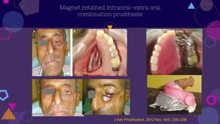 Magnet retained intraoral-extra oral
combination prosthesis
J Adv Prosthodont. 2012 Nov; 4(4): 235–238.
 