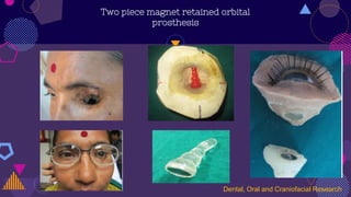 Two piece magnet retained orbital
prosthesis
Dental, Oral and Craniofacial Research
 