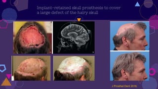 Implant-retained skull prosthesis to cover
a large defect of the hairy skull
J Prosthet Dent 2016;
 