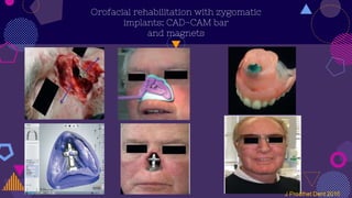 Orofacial rehabilitation with zygomatic
implants: CAD-CAM bar
and magnets
 