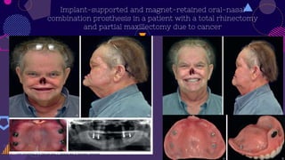 Implant-supported and magnet-retained oral-nasal
combination prosthesis in a patient with a total rhinectomy
and partial maxillectomy due to cancer
 