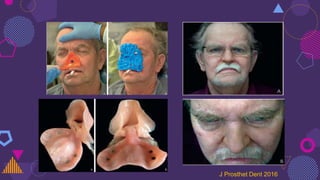 J Prosthet Dent 2016
 