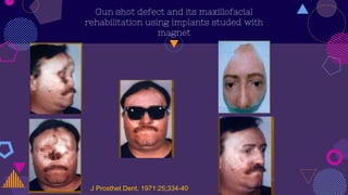 Gun shot defect and its maxillofacial
rehabilitation using implants studed with
magnet
J Prosthet Dent. 1971:25;334-40.
 