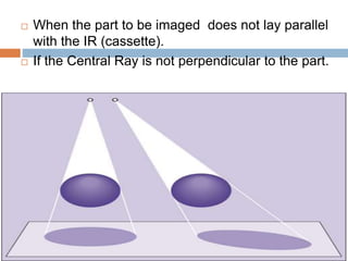  When the part to be imaged does not lay parallel
with the IR (cassette).
 If the Central Ray is not perpendicular to the part.
 