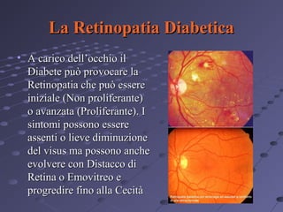 La Retinopatia Diabetica
• A carico dell’occhio il
Diabete può provocare la
Retinopatia che può essere
iniziale (Non proliferante)
o avanzata (Proliferante). I
sintomi possono essere
assenti o lieve diminuzione
del visus ma possono anche
evolvere con Distacco di
Retina o Emovitreo e
progredire fino alla Cecità

 