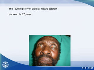 R I D - 3132
The Touching story of bilateral mature cataract
Not seen for 27 years
 