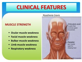 Mahareak myasthenia | PPTX