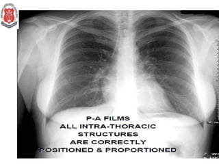 Chest X Ray INTERPRETATION IN PEDIATRICS.pptx