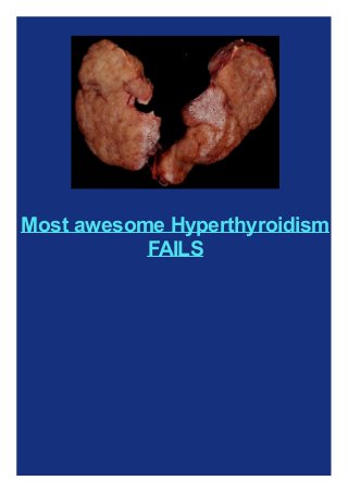 Most awesome Hyperthyroidism
FAILS

 