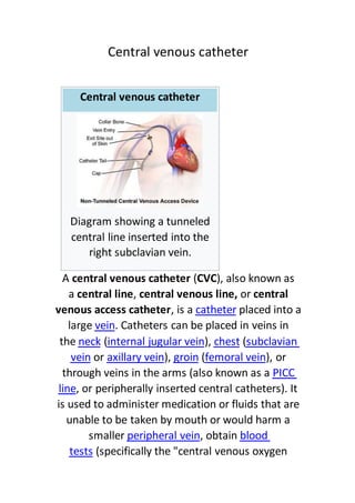 Central venous catheter
Central venous catheter
Diagram showing a tunneled
central line inserted into the
right subclavian vein.
A central venous catheter (CVC), also known as
a central line, central venous line, or central
placed into acathetera, isvenous access catheter
. Catheters can be placed in veins inveinlarge
subclavian(chest),internal jugular vein(neckthe
), orfemoral vein(groin),axillary veinorvein
PICCthrough veins in the arms (also known as a
, or peripherally inserted central catheters). Itline
is used to administer medication or fluids that are
unable to be taken by mouth or would harm a
blood, obtainperipheral veinsmaller
(specifically the "central venous oxygentests
 