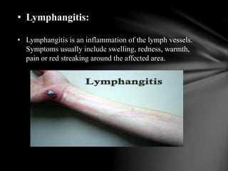 • Non-Hodgkin's Lymphoma:
 