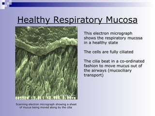 Healthy Respiratory Mucosa
This electron micrograph
shows the respiratory mucosa
in a healthy state
The cells are fully ciliated
The cilia beat in a co-ordinated
fashion to move mucus out of
the airways (mucociliary
transport)

Scanning electron micrograph showing a sheet
of mucus being moved along by the cilia

 