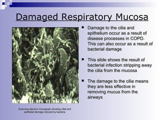 Damaged Respiratory Mucosa




This slide shows the result of
bacterial infection stripping away
the cilia from the mucosa



Scanning electron micrograph showing cilial and
epithelial damage induced by bacteria

Damage to the cilia and
epithelium occur as a result of
disease processes in COPD.
This can also occur as a result of
bacterial damage

The damage to the cilia means
they are less effective in
removing mucus from the
airways

 