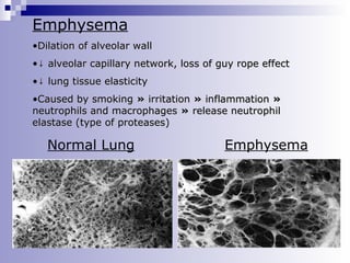 Emphysema
•Dilation of alveolar wall
•↓ alveolar capillary network, loss of guy rope effect
•↓ lung tissue elasticity
•Caused by smoking » irritation » inflammation »
neutrophils and macrophages » release neutrophil
elastase (type of proteases)

Normal Lung

Emphysema

 