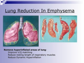 Lung Reduction In Emphysema
↑

↑

↓

↓

↑

↓

↑

↓

↑

↑

↓

↓

Remove hyperinflated areas of lung:
Improve V/Q matching
Reduce resting length of respiratory muscles
Reduce Dynamic Hyperinflation

 