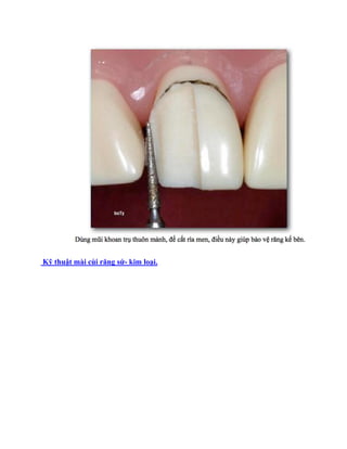 Kỹ thuật mài cùi răng sứ- kim loại.
 