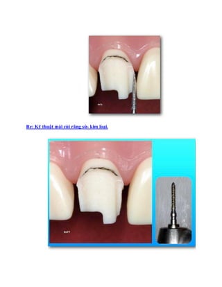 Re: Kỹ thuật mài cùi răng sứ- kim loại.
 