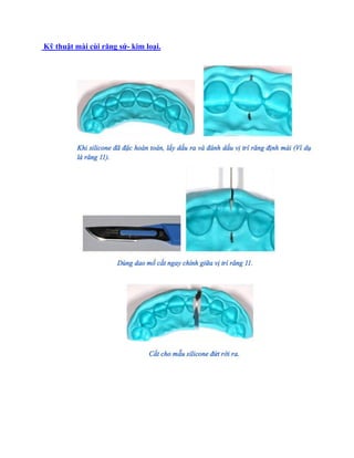Kỹ thuật mài cùi răng sứ- kim loại.
 