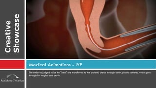 The embryos judged to be the "best" are transferred to the patient's uterus through a thin, plastic catheter, which goes through her vagina and cervix. Medical Animations - IVF Creative Showcase 