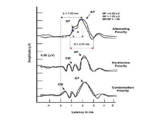Mai EchoG and OAEs ENT [Recovered].pptx