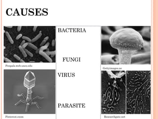 CAUSES
BACTERIA
FUNGI
VIRUS
PARASITE
BACTERIA
FUNGI
VIRUS
PARASITE
Penpals.web.unco.edu
Gettyimages.ae
Pinterest.coom Researchgate.net
 