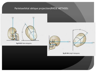 Reverse Rhese Method Imaging in Ocular Pathologies | PPTX