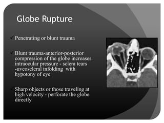 Globe Rupture Memory Note Imaging in Ocular Pathologies | PPTX