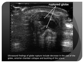 Globe Rupture Memory Note Imaging in Ocular Pathologies | PPTX