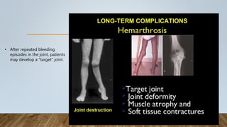 • After repeated bleeding
episodes in the joint, patients
may develop a "target" joint.
 