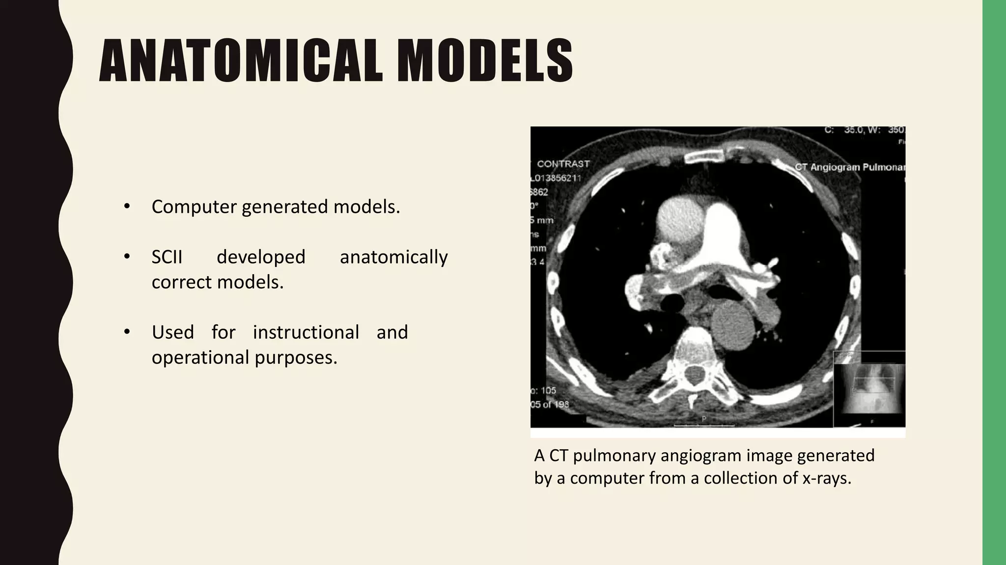 ANATOMICAL MODELS
• Computer generated models.
• SCII developed anatomically
correct models.
• Used for instructional and
operational purposes.
A CT pulmonary angiogram image generated
by a computer from a collection of x-rays.
 