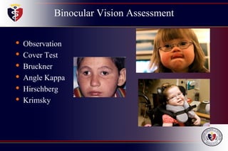 Binocular Vision Assessment
• Observation
• Cover Test
• Bruckner
• Angle Kappa
• Hirschberg
• Krimsky
 