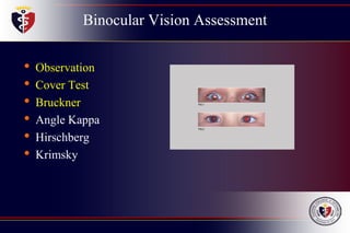 Binocular Vision Assessment
• Observation
• Cover Test
• Bruckner
• Angle Kappa
• Hirschberg
• Krimsky
 