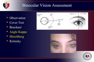 Binocular Vision Assessment
• Observation
• Cover Test
• Bruckner
• Angle Kappa
• Hirschberg
• Krimsky
 