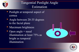 Tangential Penlight Angle
Estimation
• Penlight at temporal aspect of
cornea
• Angle between 20-35 degrees
to the facial plane
• Maximum brightness
• Open angle = nasal
illumination at least 75% as
bright as temporal
illumination
 