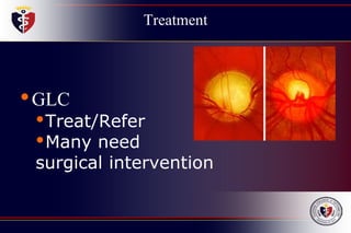 Treatment
•GLC
•Treat/Refer
•Many need
surgical intervention
 